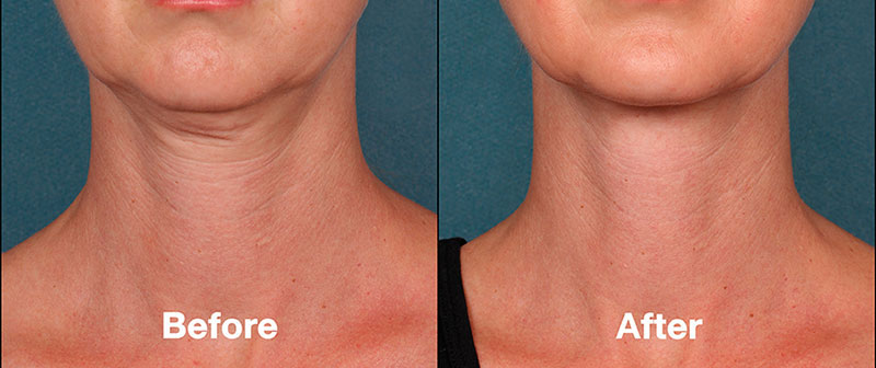 KYBELLA injection treatment before/after