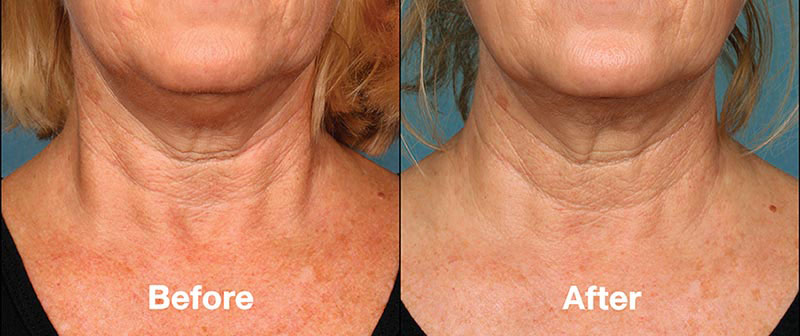 KYBELLA injection treatment before/after