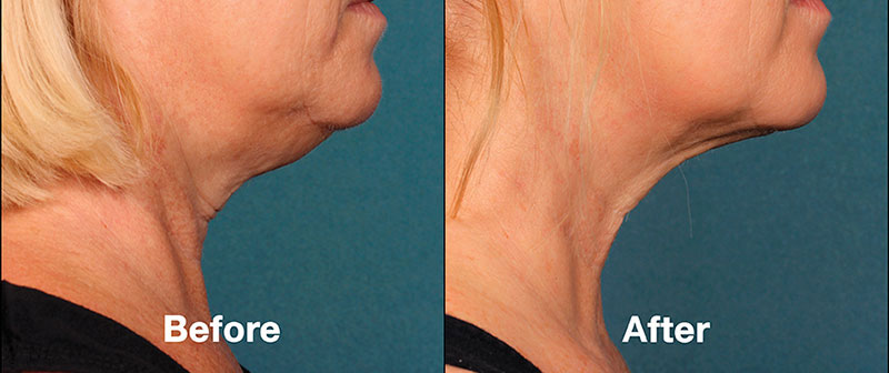 KYBELLA injection treatment before/after