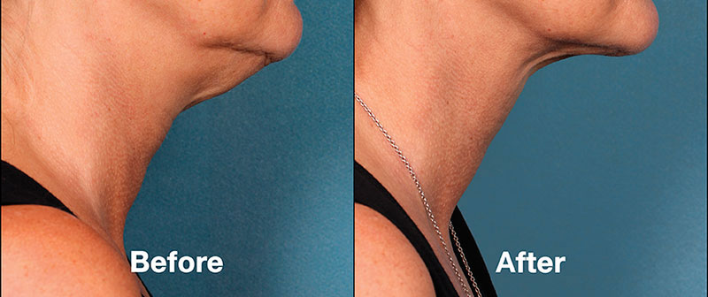 KYBELLA injection treatment before/after